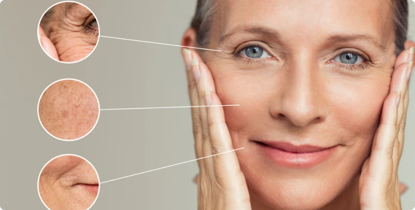 Prevenção de rugas com botox em Fortaleza