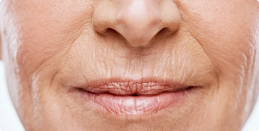 Tratamento de rugas com botox em fortaleza