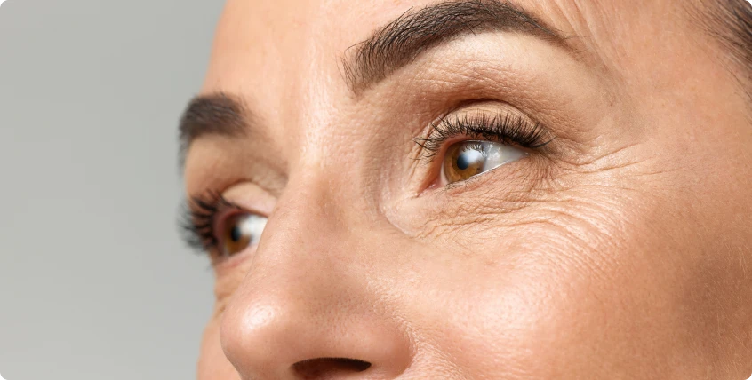 botox para rugas